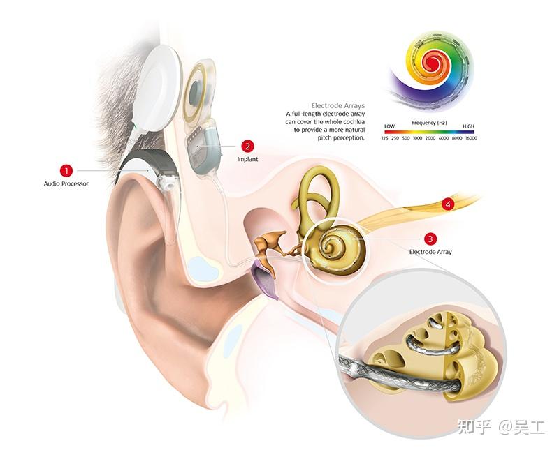 电子耳蜗:先天性耳聋患儿的福音-健康频道-手机